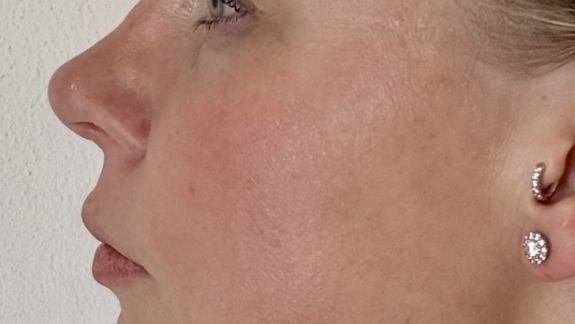 Kunde med akne hos kosmetisk klinik på Fyn