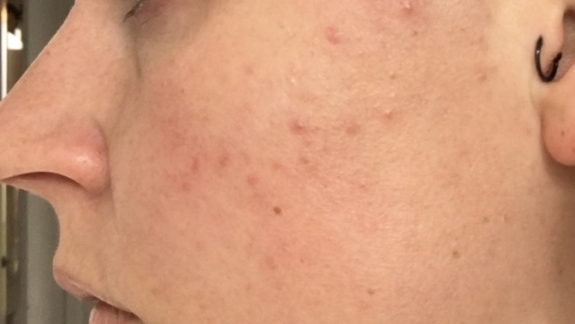 Kunde med akne hos kosmetisk klinik på Fyn