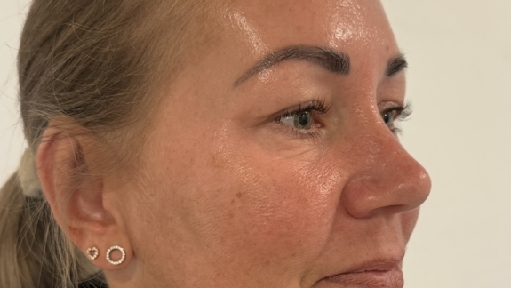 Kunde der har rosacea og er i behandling hos Fyrsterling Clinic i Odense