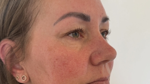 Kunde der har rosacea og er i behandling hos Fyrsterling Clinic i Odense