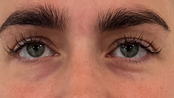 PRF skinbooster behandling hos Fyrsterling Clinic i Odense