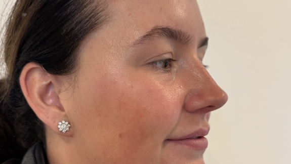 Kunde med akne hos Fyrsterling Clinic i Odense på Fyn