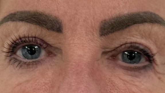 Kunde der skal have botox for et brynløft hos Fyrsterling Clinic i Odense