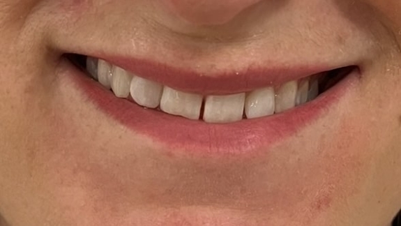 Botox behandling med lipflip til kunde hos skønhedsklinik i Odense