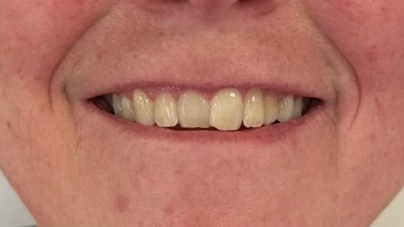 Kunder der har fået botox for lipflip hos kosmetisk klinik på Fyn