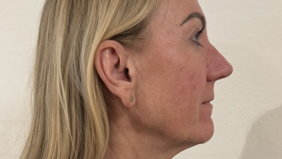 Kunde der har fået botox for nefertitisløft hos skønhedsklinik på Fyn