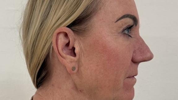 Kunde der skal have botox for nefertitisløft hos skønhedsklinik på Fyn