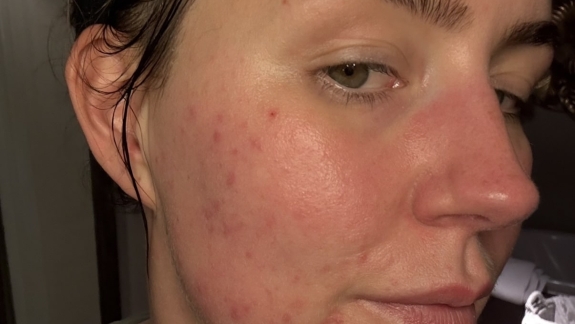 Kunde med akne hos Fyrsterling Clinic i Odense på Fyn