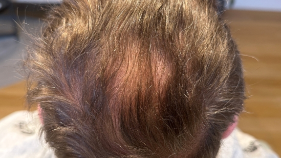 Behandling mod hårtab hos Fyrsterling Clinic i Odense