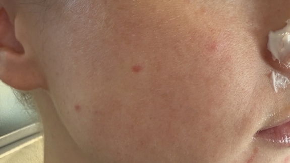 Kunde efter IPL behandling og ZO Skin Health