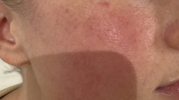 Før IPL og ZO Skin Health hudpleje