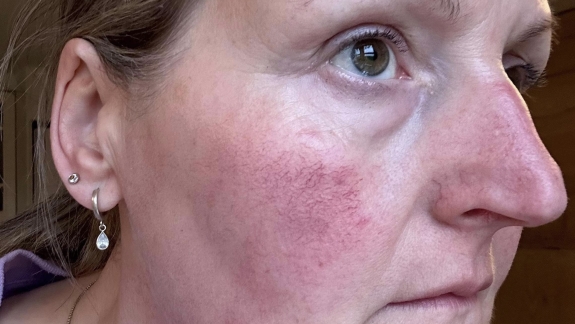 Før behandling med IPL og ZO Skin Health