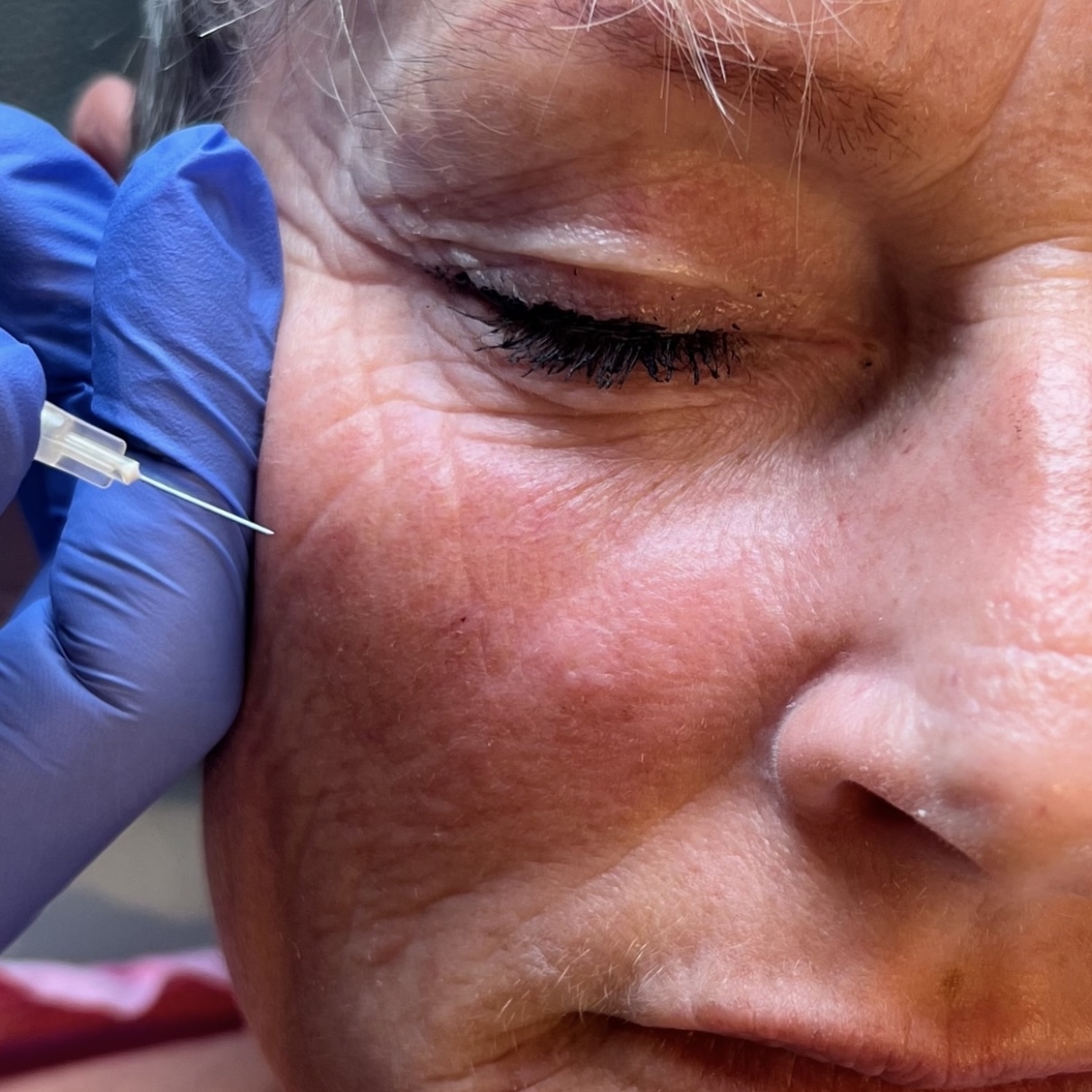 Kunde der får skinbooster behandling hos speciallægeklinik i Odense på Fyn når Svendborg