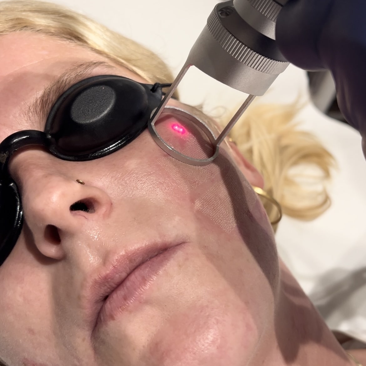 Kunde der får CO2 laserbehandling mod aknear i Odense hos Fyrsterling Clinic