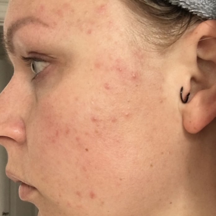 Akne kunde hos kosmetisk klinik i Odense på Fyn
